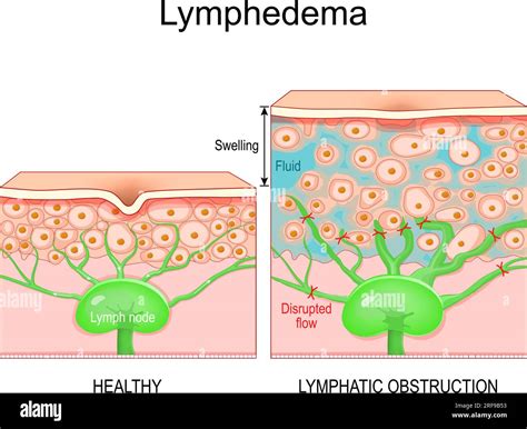 Lymphedema