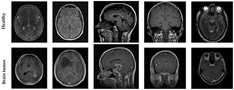 MRI for Brain Damage Detection