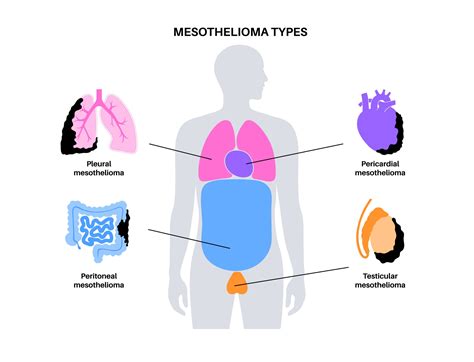 Main Types of Mesothelioma