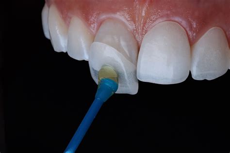 Maintaining and Caring for Your Restored Veneer Tooth
