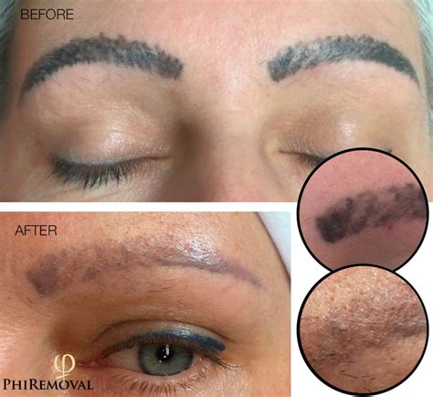 Laser Tattoo Removal of Semi permanent Makeup and