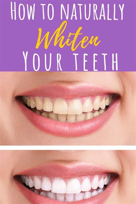 Making Teeth Look Naturally White