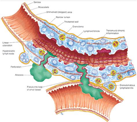 Apa yang dimaksud dengan Malabsorbsi Makanan atau Intestinal