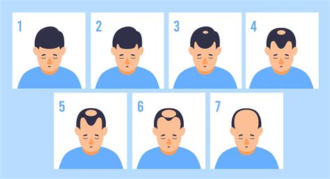 Male-Pattern Baldness