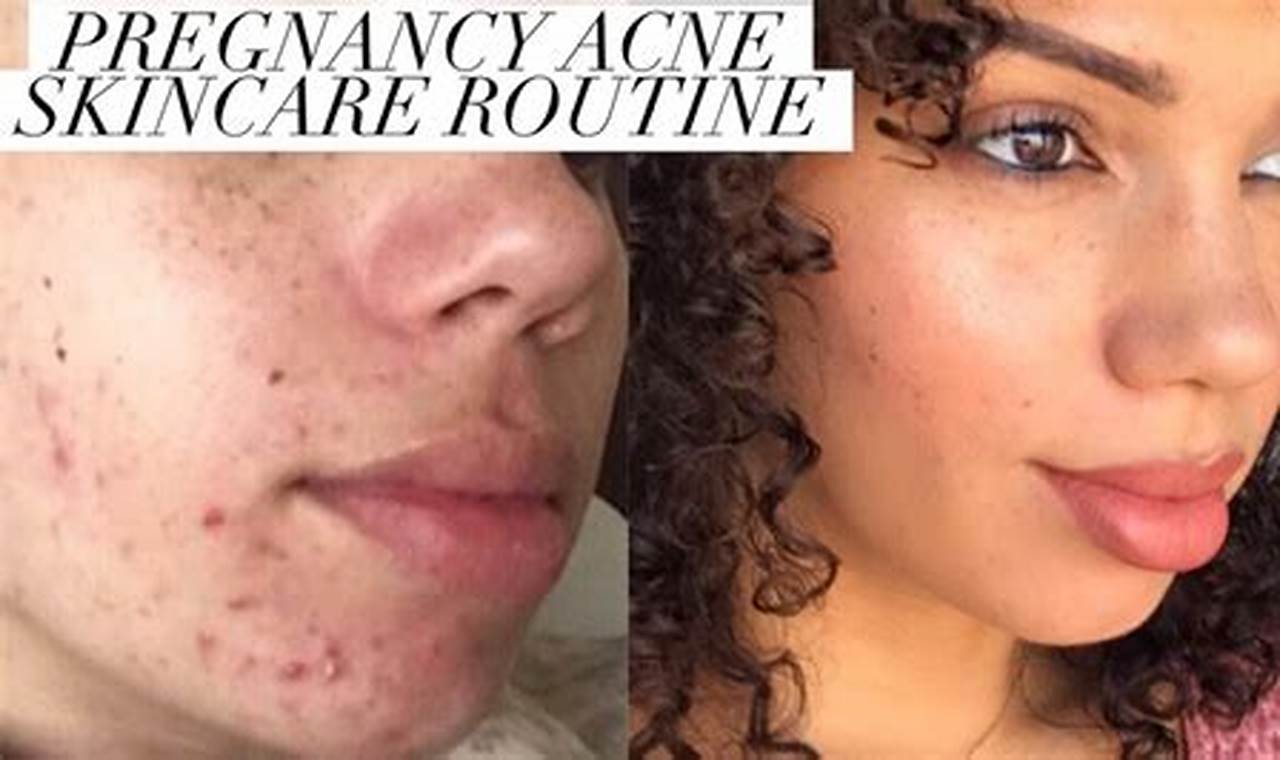 Managing pregnancy-related acne breakouts