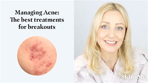 Managing Breakouts and Acne