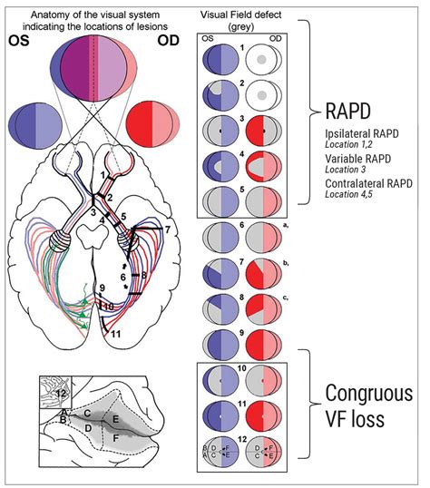 Managing Visual Field Loss