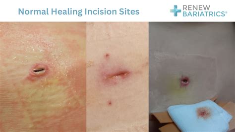 Managing the Incision Site