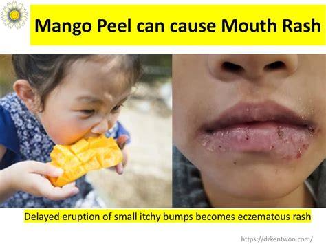 Mango Rash