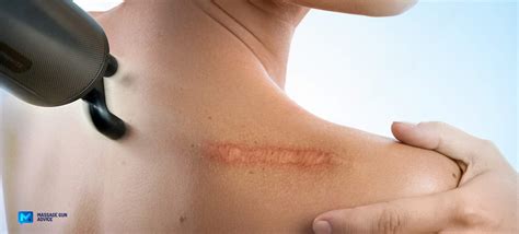 Massage Gun Scar Tissue