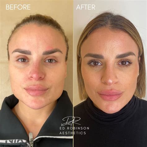 Masseter Botox Stress Relief