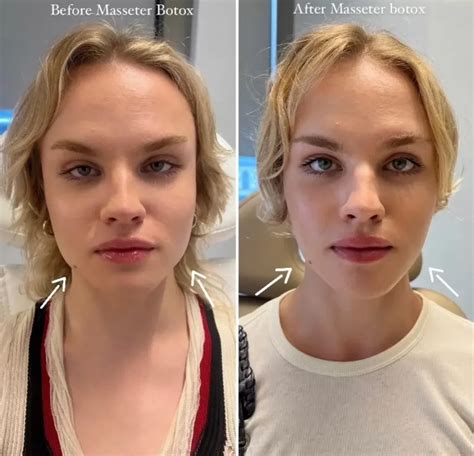 Masseter Botox in Education