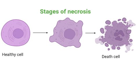 Unveiling the Mysteries of Necrosis: A Comprehensive Medical Definition