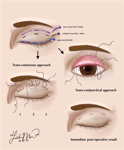 Medical Evaluation for Eyelid Surgery