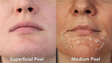 Medium Peels