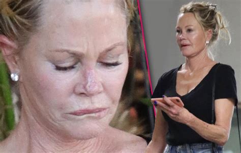 Unveiling the Disturbing Truth: Melanie Griffith's Brave Battle Against Skin Cancer