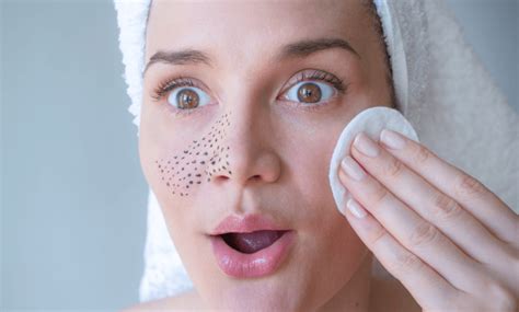 Memudarkan Bintik Hitam