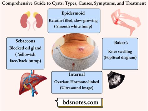 Men's Cysts: Types, Causes & Treatment Options.