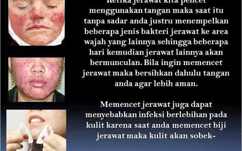 Mengapa Orang Yang Jerawat Tidak Boleh Makan?