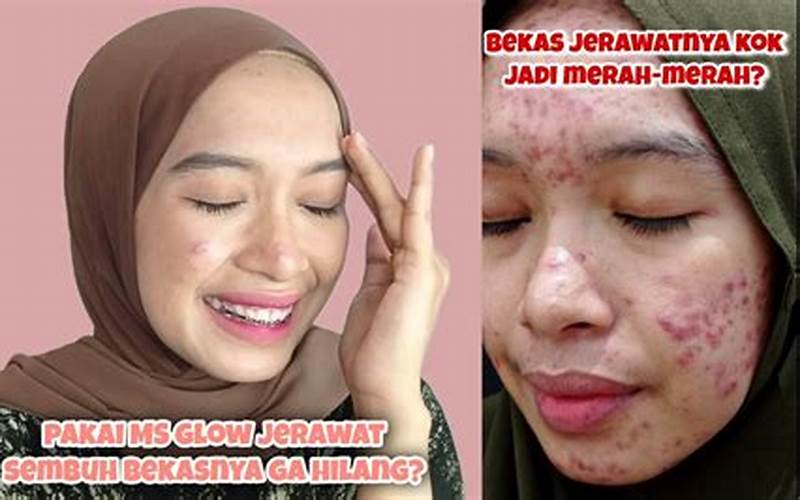 Mengatasi Bekas Jerawat Merah Dengan Ms Glow