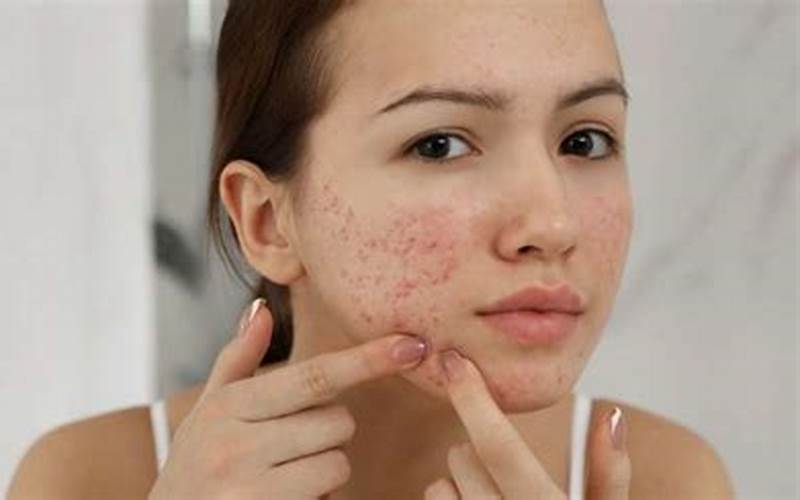 Mengenal Skincare Untuk Jerawat Pada Wanita