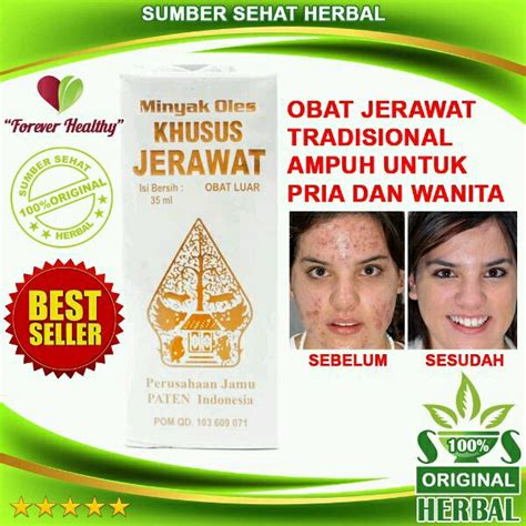 Mengenal 5 Obat Jerawat Tradisional Yang Ampuh Dan Aman Bagi Kulit Wajah