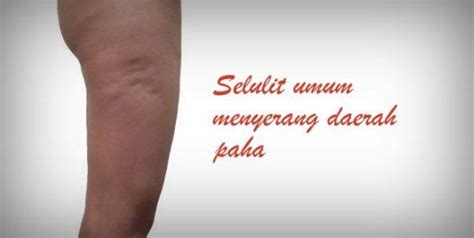 Mengurangi Selulit