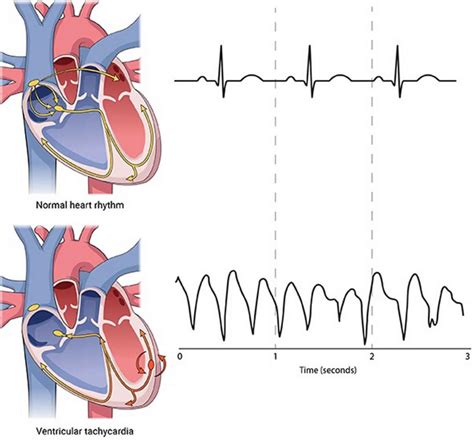Image: Mental Health and Well-being Ventricular Fibrillation