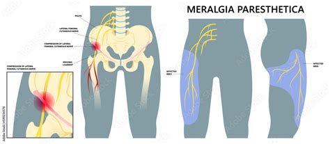 Doctors specializing in Meralgia Paresthetica