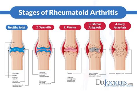 Mercola Rheumatoid Arthritis