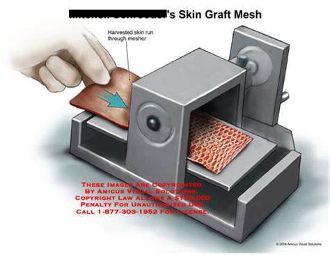 Achieving Flawless Skin: The Innovative Mesher For Skin Graft You Need to Know About!