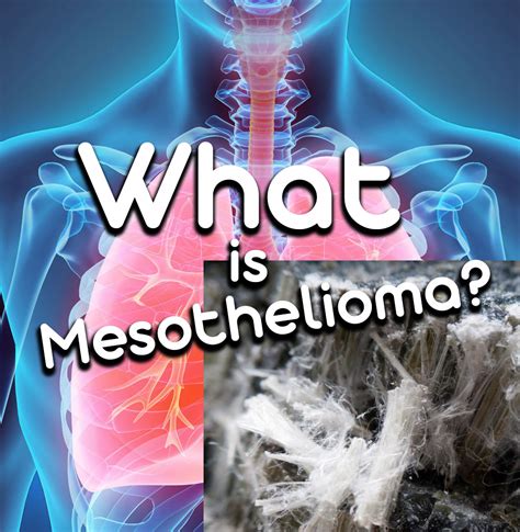 Mesothelioma in Young Adults