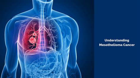 Mesothelioma Cancer