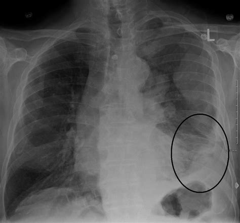 Mesothelioma Chest X Ray image