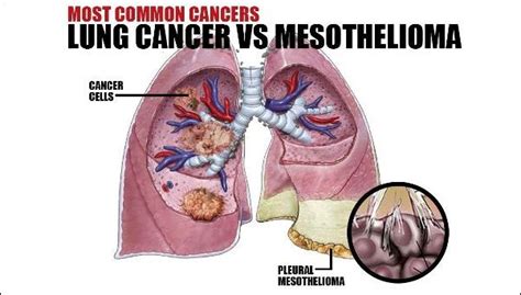 Mesothelioma versus Lung Cancer comparison