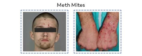 Flesh Becomes The Enemy: Unveiling The Alarming Reality of Methamphetamine Emerging From The Skin