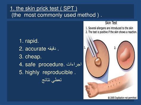 Method 1: Skin Prick Tests (SPT)