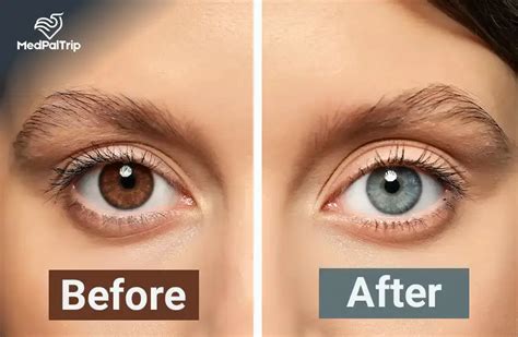 Methods for Intentional Eye Color Change