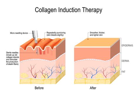 MicroNeedling Diagram Explaining Derma Stamp Matas
