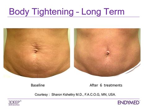 Reveal a Youthful Glow with Microneedling for Loose Skin: The Ultimate Solution to Tighten and Tone