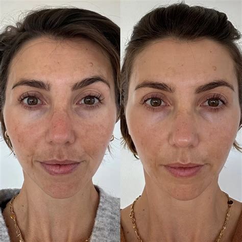 Microneedling Treatment