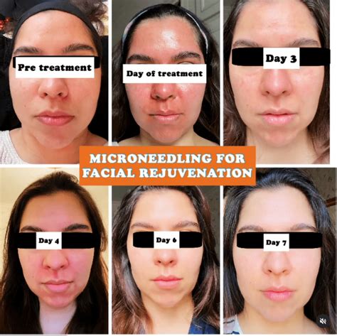 Microneedling procedure
