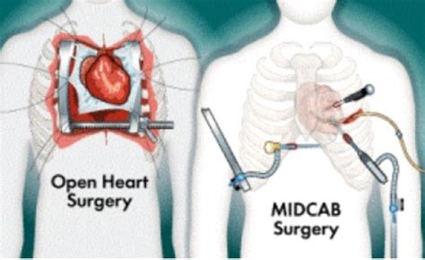 Midcab