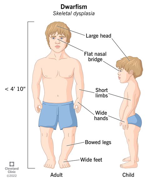 Short and Sweet: Determining the Difference between Midget and Dwarf