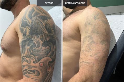 Before and After Laser Tattoo Removal — MJ Driver Laser