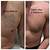 Mike Driver Laser Tattoo Removal