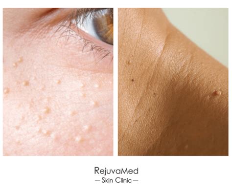 Milia Vs Skin Tag: The Battle of Bumps on Your Skin Unveiled!