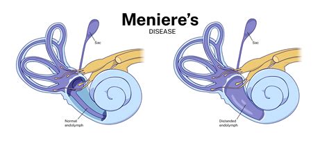 Miners Disease