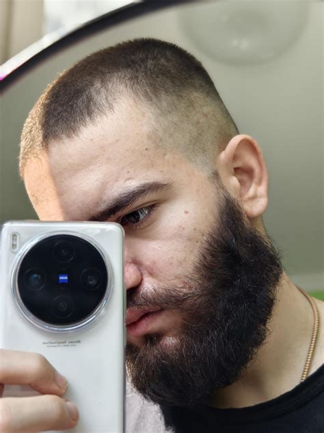 Minoxidil's transformative journey