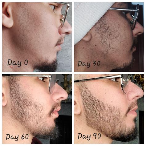 Minoxidil Beard Progress Pictures